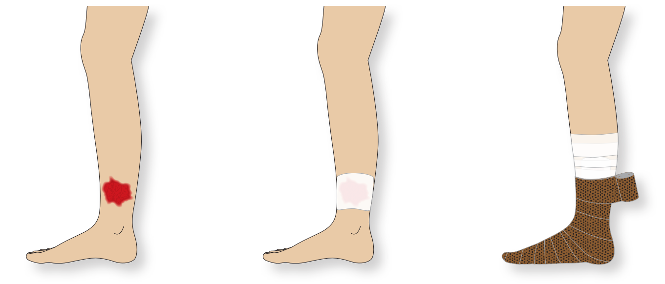 Nässt op hallux wunde nach ᐅ Tipps